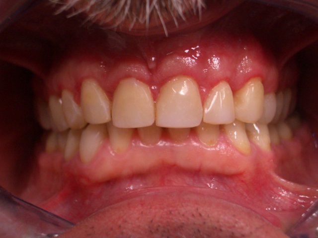 coronoplastica odontoplastica dopo