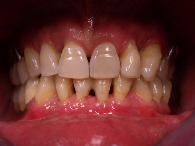 denti mobili con retainer linguale coronoplastica dopo