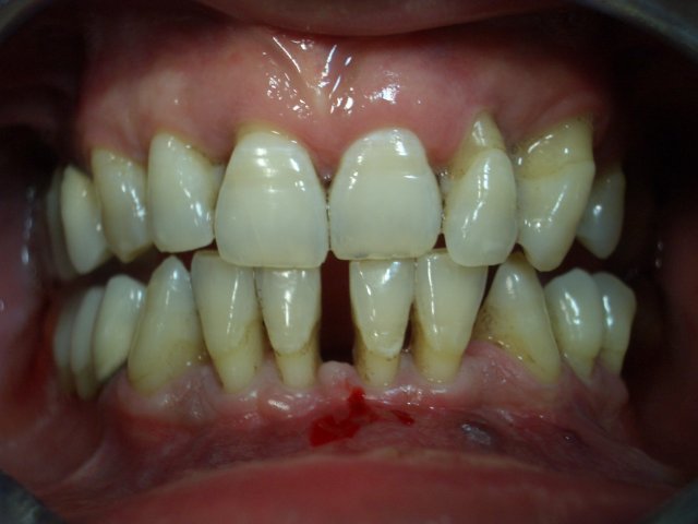 denti mobili con retainer linguale coronoplastica prima