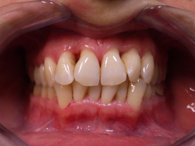 gengivite-piorrea con grave perdita di ossomobilit dentale alterazioni dell'estetica delle gengive