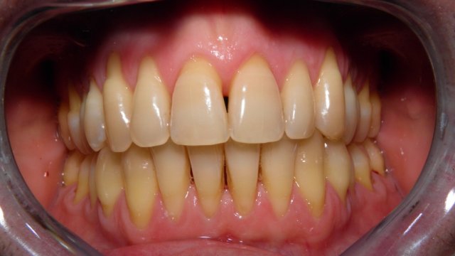 ortodonzia caso finale