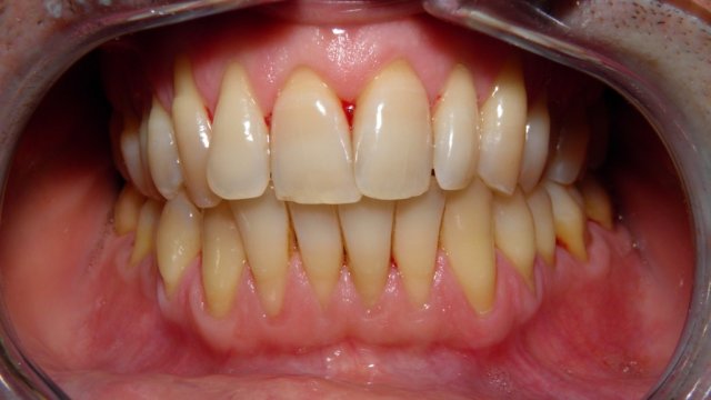 ortodonzia caso iniziale