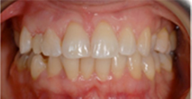 ortodonzia invisibile salerno dopo