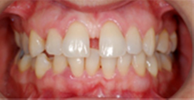 ortodonzia invisibile salerno prima
