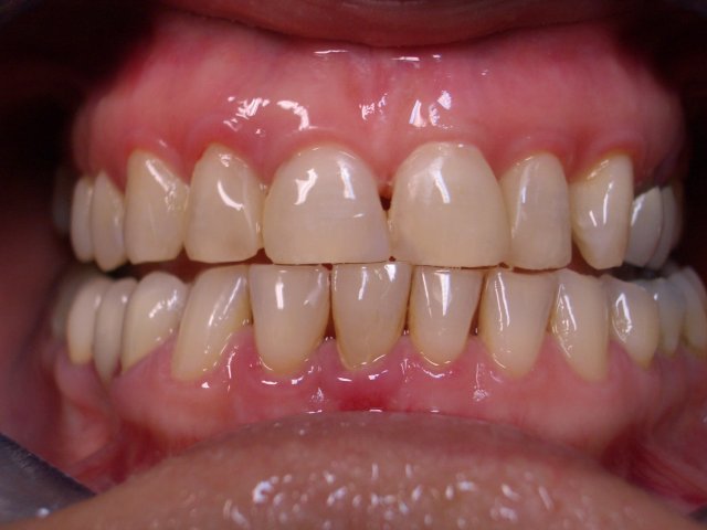 coronoplastica--odontoplastica-dopo-con-chiusura-dei-diastemi